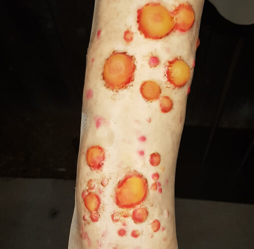 Infectious pustules on arm